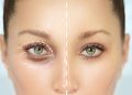 Trei lucruri pe care trebuie să le știi înainte de a face blefaroplastie