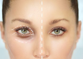 Trei lucruri pe care trebuie să le știi înainte de a face blefaroplastie