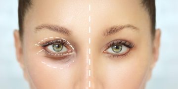 Trei lucruri pe care trebuie să le știi înainte de a face blefaroplastie